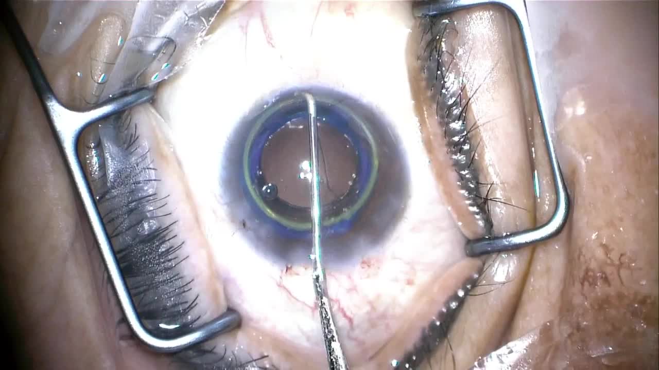 Juvene IOL Insertion