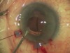 IOL Exchange with IOL Explant of Piggyback  Plate-haptic PC-IOLs using Grieshaber DSP MAXGrip Forceps with Iris Repair