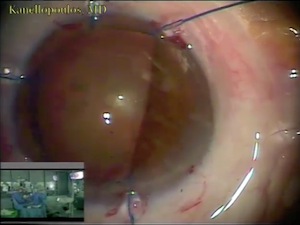 Floppy Iris Syndrome