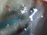 Sealing NPDS Flap with Fibrin Glue