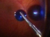 ILM Peeling in Macula Hole Case with One Drop Technique