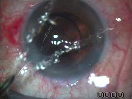 Intraocular Lens Implantation Without OVD