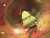 Five Steps to Canaloplasty Success
