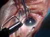 Cataract Surgery Behind a Semi-Opaque Corneal Implant