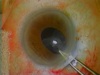Post-operative Solutions