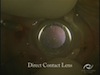 Volk's MERLIN Surgical System in Macular Hole Surgery