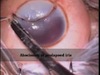 Irony of Diwali - Surgical Management of Two Firecracker Injury cases