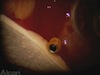 Cannula Drainage of Choroidals