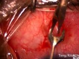 Trabeculectomy with Mitomycin C Limbus Based OD