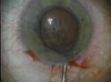 Iris Prolapse