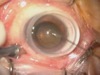 27-gauge Nonvitrectomizing Epiretinal Membrane Peeling