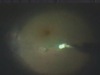 ICG Staining of ERM