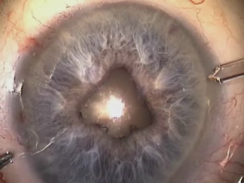 Difficult Cases - Flomax with Bound Down Pupil