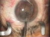 Bimanual Cataract Surgery with No Phaco Power on a 3+ NS