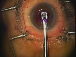 Kamra Corneal Inlay Implantation for Post-LASIK Patients