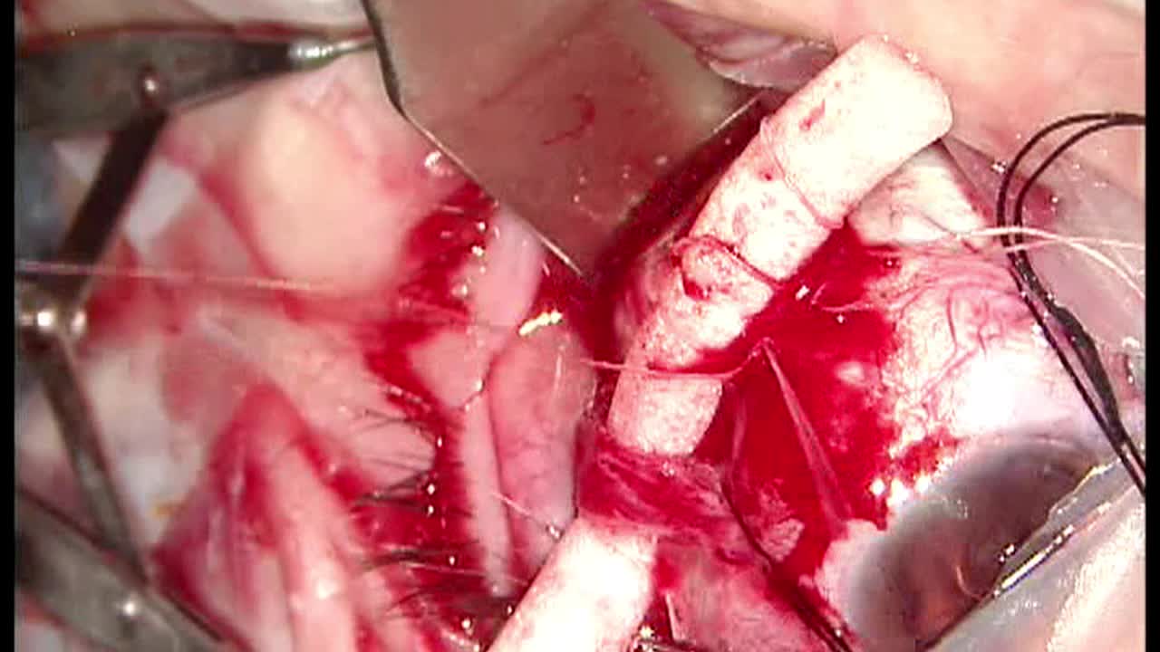 Chandelier Scleral Buckle Procedure