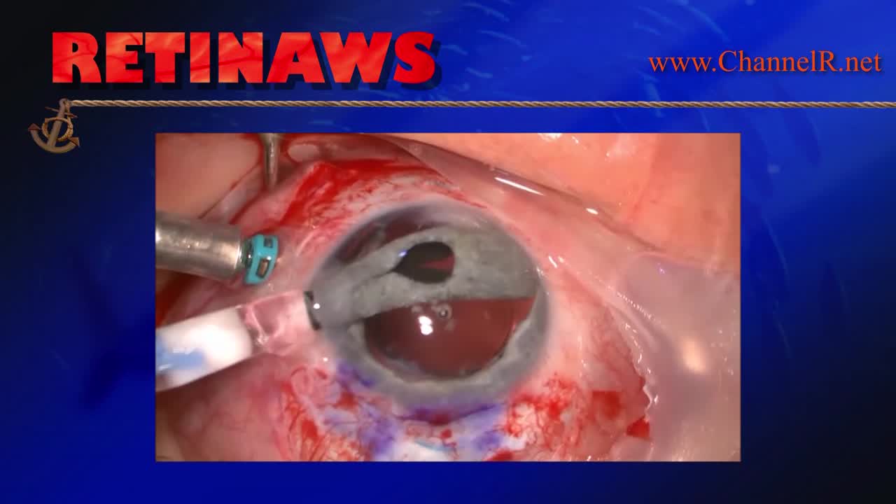Iris-Lens Reconstruction