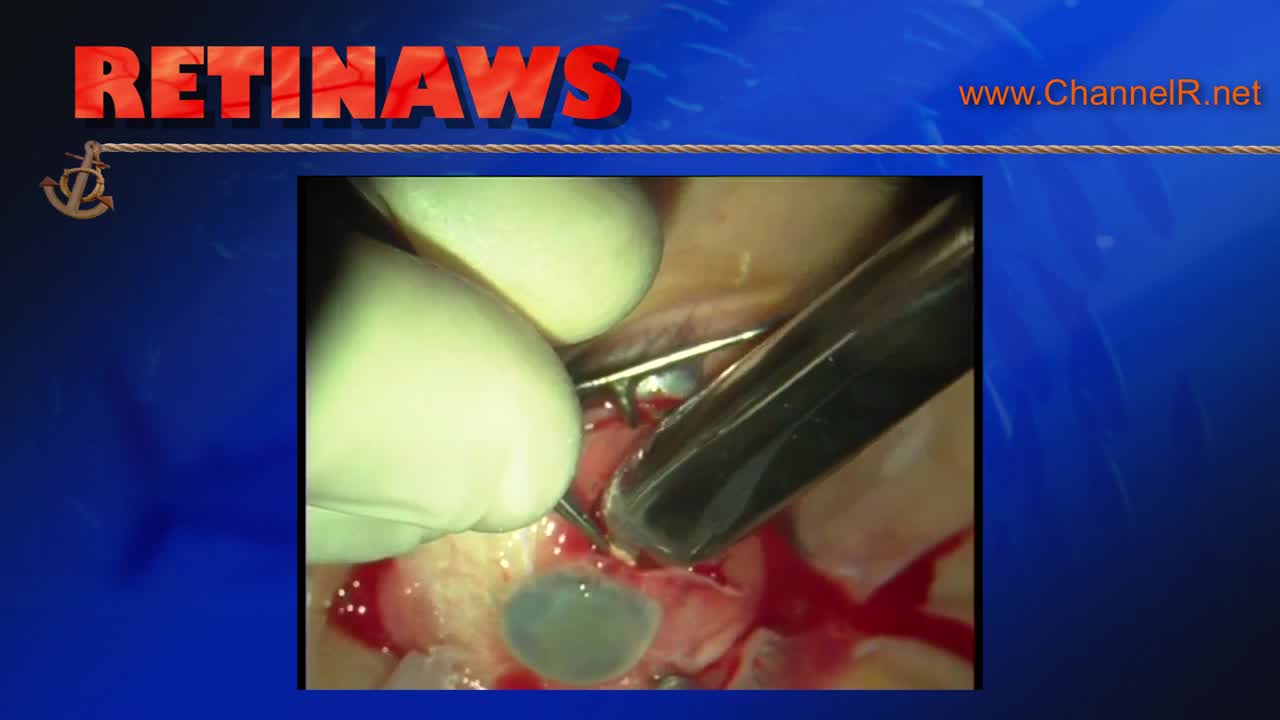 Pre-Phthisical Eye