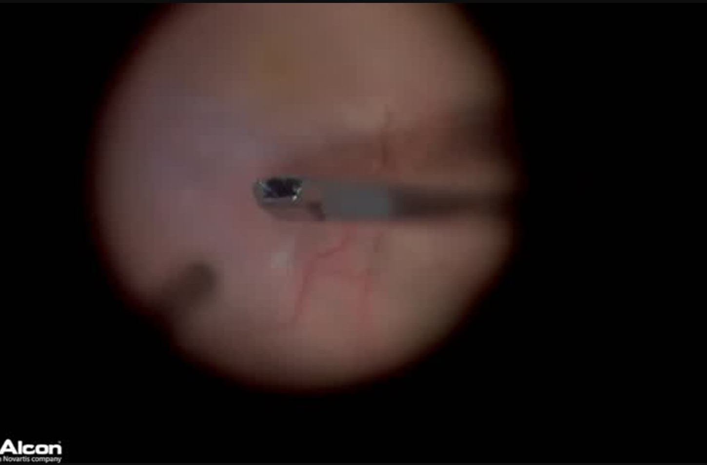 A Different Approach to a Common Problem