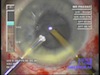 Radial Keratotomy - Boon or Bane