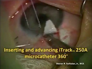 Trabeculotomy using the iTrack Microcatheter