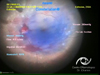 ILM peeling in diabetic proliferative retinopathy