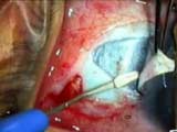 Pediatric Trabeculotomy with the iScience Catheter