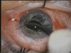 Traumatic Mydriasis