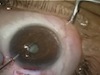 Cataract Surgery in the High Hyperope