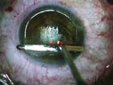 LASIK in Post-RK Eye with Ziemer LDV 