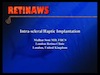Intra-scleral Haptic Implantation