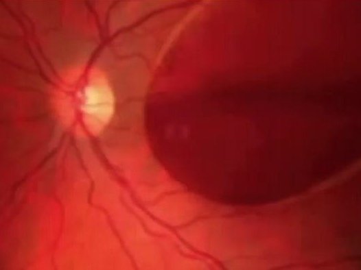 Vitrectomy for Valsalvas