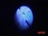 Epiretinal Membrane Peel of Combined Hamartoma of the Retina and RPE
