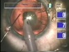 Posterior Lentiglobus