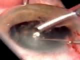 Torsional Phaco
