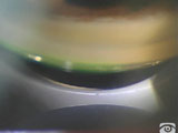 Pupillary Block, Narrow Angle PAS on Indentation Gonioscopy