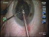 Pseudoexfoliation: Small Pupil, Loose Zonules