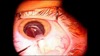 Sulcoflex Multifocal Implantation