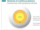 Presbyopic LASIK by Micro-Monovision using increased depth of field from non-linear aspheric profiles