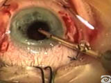 Posterior chamber lens implantation with transscleral suture fixation