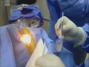 Introduction of the Visian ICL Preloaded Lens
