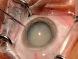 Microincisional Capsulorhexis
