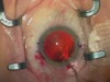 Live Surgery with ASICO