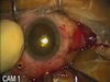 23-Gauge Vitrectomy with Brilliant Blue Assisted ILM Peeling in a High Myopic Macular Schisis