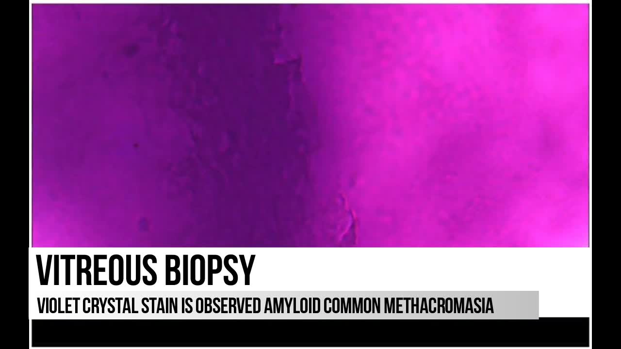 Vitreous Amyloidosis