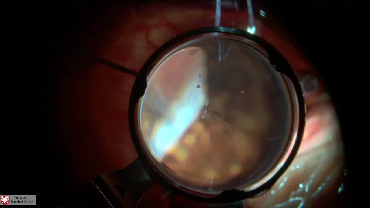 Retinal Fold