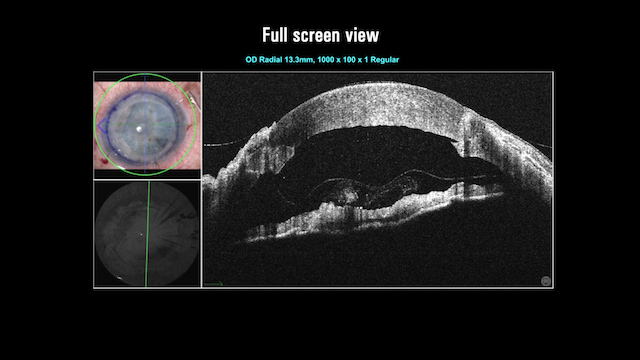 More Insights during DMEK Surgery with Enfocus Intrasurgical OCT