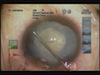 White Cataract