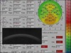 Deformation Responses of Normal and Ectatic Cornea