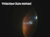 Vitrectomy for Vitreous Opacities Floater only Vitrectomy High Definition